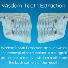 Image result for Tooth Extraction