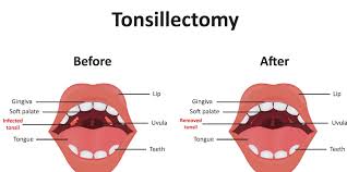 Image result for Tonsillectomy