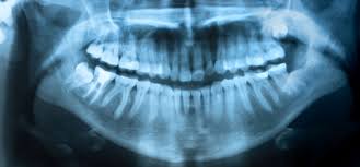 Genetics is one of the most prevalent causes of this condition. What Is A Crossbite Westermeier Martin Dental Care
