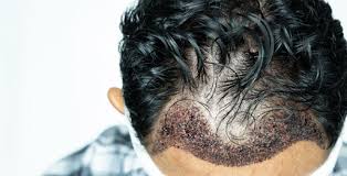 È molto comune infatti che nel post operatorio si . Trapianto Capelli Cosa Accade Dopo