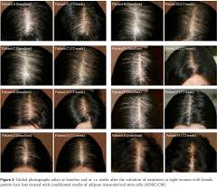 Stem cell treatments have been available around the world for more than a decade. New Study Use Of Aape Adipose Derived Stem Cell Conditioned Media Adsc Cm In Female Pattern Hair Loss Bauman Medical