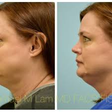 TOP 10 BEST Hair Transplant near The Colony, TX