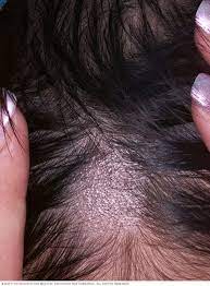 Ringworm on scalp is a fungal infection of the scalp and the hair shaft. Ringworm Scalp Symptoms And Causes Mayo Clinic