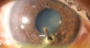 Image result for Eye Foreign Body