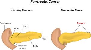 Many are similar to those of other conditions. Pancreatic Cancer Causes Symptoms Treatment In Bangalore