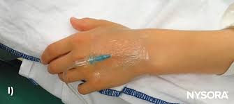 Image result for Difficult Intravenous Access in Children