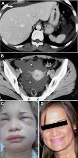 Figure. Manifestations of HAE with normal C1-INH. A, Computerized...