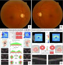 Your eye doctor may use one of these optic nerve computer imaging techniques as part of your glaucoma examination. Optic Disc Photograph And Analysis Of Different Scanning Regions Download Scientific Diagram