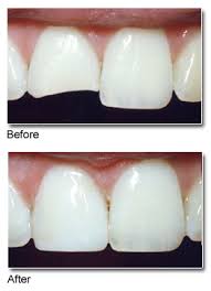 Millennials are suffering from tooth pain and untreated cavities at record rates, which has affected many even in their ability to socialize and interview for a job. Dental Bonding Tyngsboro Dental Practice