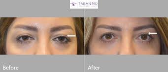 Washingtonians prefer subtle enhancements with minimal downtime and no evidence of surgery. Canthoplasty Photos Mehryar Ray Taban Md