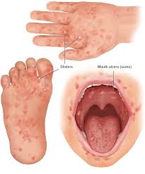 Image result for Hand foot and mouth disease HFMD roof of mouth