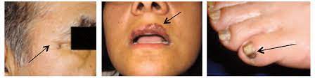 Not applying enough (most of us use only 25% to 50% of the right amount, which is about one ounce or a shot glass' worth) and missing spots. Skin Cancer In People Of Color