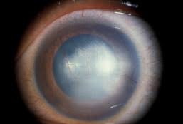 Herpes simplex virus (hsv) is a very common infection that has been reported to be present in the trigeminal ganglion of nearly 100% of patients greater than age 60 at autopsy. Interstitial Keratitis Eyewiki