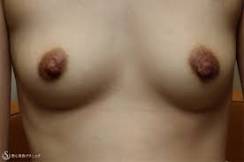 30代女性・乳首を小さく】乳頭縮小（1ヶ月後） - 症例写真 - 美容整形、美容外科なら聖心美容クリニック