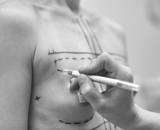 Gynaecomastia - Male Breast Reduction Surgery In Dubai