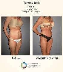 It should not be used as an alternative to weight loss. Exercise After Tummy Tuck When Is It Safe To Resume Running Lifting More In Denver Center For Cosmetic Surgery