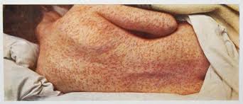 Image result for measles