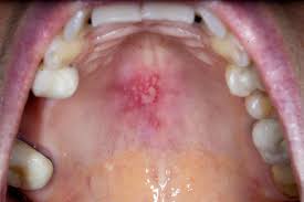Image result for oral herpes symptoms roof of the mouth