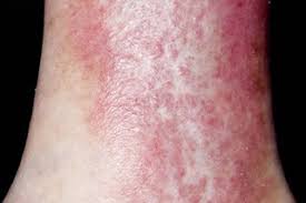 Image result for Stasis Dermatitis
