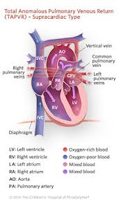 Do not try and dox anomaly or his family. Total Anomalous Pulmonary Venous Return Tapvr Children S Hospital Of Philadelphia