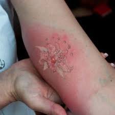 Signs Of Infection After Laser Tattoo Removal Laser Tattoo Laser Tattoo Removal Skin Care Treatments