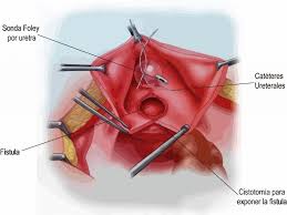 Capítulo 19 – Cirugía reconstructiva en urología – Manual de Urología