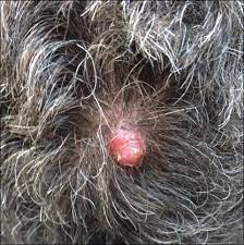 Skin cancer is one of the most common types of cancer. Firm Pink Nodule On The Scalp Mdedge Dermatology