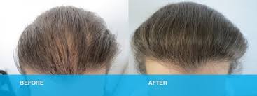 Female pattern hair loss is the most common hair disorder in women. Female Hair Loss Treatment Gold Coast Brisbane Medici Capelli