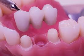 Gigi tiruan jembatan adalah restorasi yang menggantikan satu atau Rawatan Dental Bridge Di Klinik Pergigian Uitm Sg Buloh