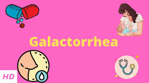 Image result for Galactorrhea