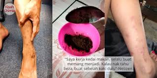 Kudis adalah suatu kondisi menular dan dapat menyebar melalui sentuhan langsung antar kulit. Pin On Viral Artis