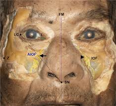 The lesion originates at the left neural foramina and grows along the course of the brachial plexus (red arrow). Location Of The Accessory Infraorbital Foramen With Reference To External Landmarks And Its Clinical Implications Scientific Reports