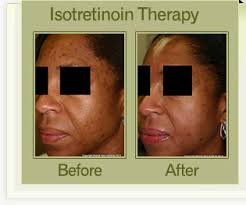 Acne Treatment Miami