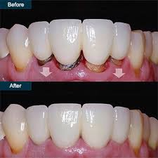 The posts act like the roots of natural teeth. Dental Bridge Brooklyn Ny Implant Bridge Brooklyn