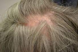 I was recently diagnosed wth lichen planopilaris (not lichen planus) and am interested in hearing from others with this condition. Lichen Planopilaris Is A Rare Inflammatory Condition That Results In Patchy Progressive Permanent Hair Hair Baldness Treatment Help Hair Loss Hair Restoration