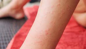 Image result for allergy rash on the legs