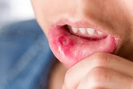 Image result for gums cancer symptoms