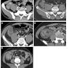 Hinchey classification is used to describe perforations of the colon due to diverticulitis. 1