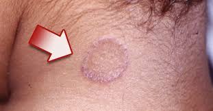 La aparición de la dolencia es bastante mas frecuente en hombres que en mujeres, es rara en los negros pero común en los blancos, especialmente en aquellos que viven en zonas. Como Eliminar Los Hongos De Cualquier Parte Del Cuerpo Con 4 Recetas Bioguia