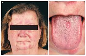 The signs and symptoms of syphilis vary depending in which of the four stages it presents (primary, secondary, latent, and tertiary). Papulonodular Syphilis Nejm