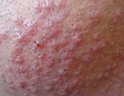 It serves a few biological functions that are worth noting. Ingrown Hair In Private Area How Qmog Fi