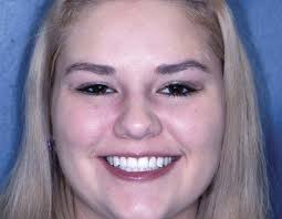 Utilizing Photography and a Diagnostic Wax-Up as Pillars of Success with  Porcelain Veneers