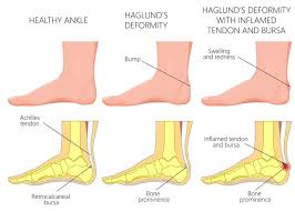 Related online courses on physioplus. Haglund S Deformity Plantar Fascia Institute Of Mn