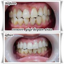 Beli gigi palsu online berkualitas dengan harga murah terbaru 2021 di tokopedia! Shiny Smile Aesthetic Dental Clinic Wedding Health Beauty In Surabaya Bridestory Com