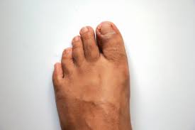 +de 100 imagenes seleccionadas!!!¿estás pensando en probar uñas acrílicas para pies este 2019? Pies De Mujer Feos Mal Cuidados Con Unas Largas De Color Salmon Necesita Pedicura Pedicura Vencida Primer Plano De Los Dedos Gordos Del Pie Apuntando Hacia Adentro Alejados Uno Del Otro Debido