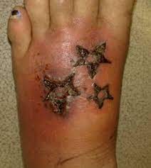 This will, therefore, reduce the smell. Infected Tattoos Signs Symptoms Warning Graphic Content Tattoodo