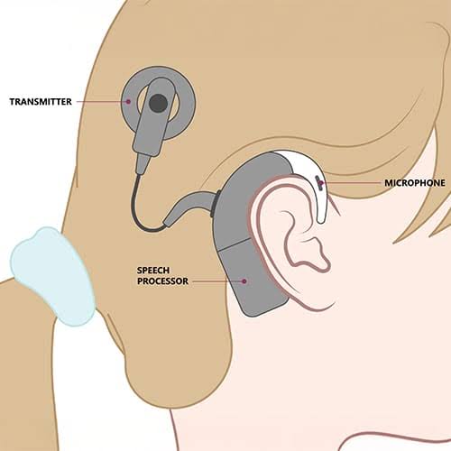 BAHA Hearing Aids Guide | Hearing Loss Solutions | Hear4U