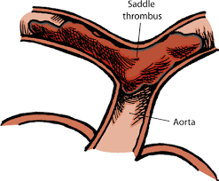 Decreased blood flow to the legs caused when a blood clot dislodges and is trapped in the pelvic end of the aorta. Blood Clots And Aneurysms In Cats Cat Owners Veterinary Manual