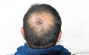 What's left of it, at least. This Guy Grew His Bald Patch Into A Business Lifestyle News