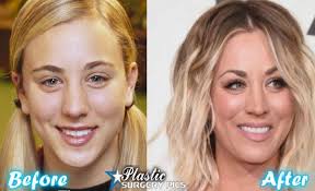Kaley Cuoco Nose Job Before And After Plastic Surgery Celebrity Teeth Rhinoplasty Nose Jobs